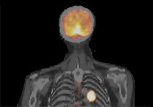 untersuchung_petct_small.jpg
